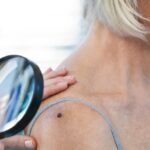 Jak odróżnić znamiona od nowotworów skóry? Innowacyjna metoda ułatwi diagnozę.