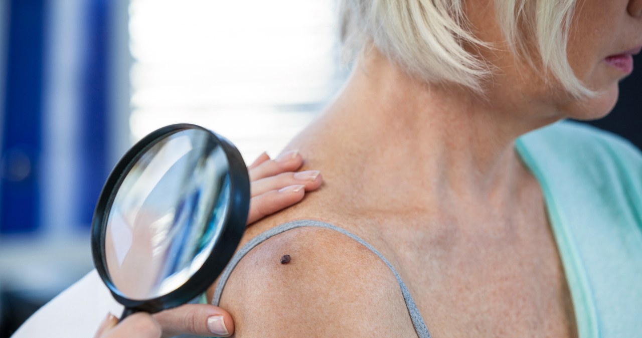 Jak odróżnić znamiona od nowotworów skóry? Innowacyjna metoda ułatwi diagnozę.